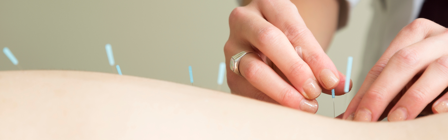 Acupuntura: usos, tipos y beneficios